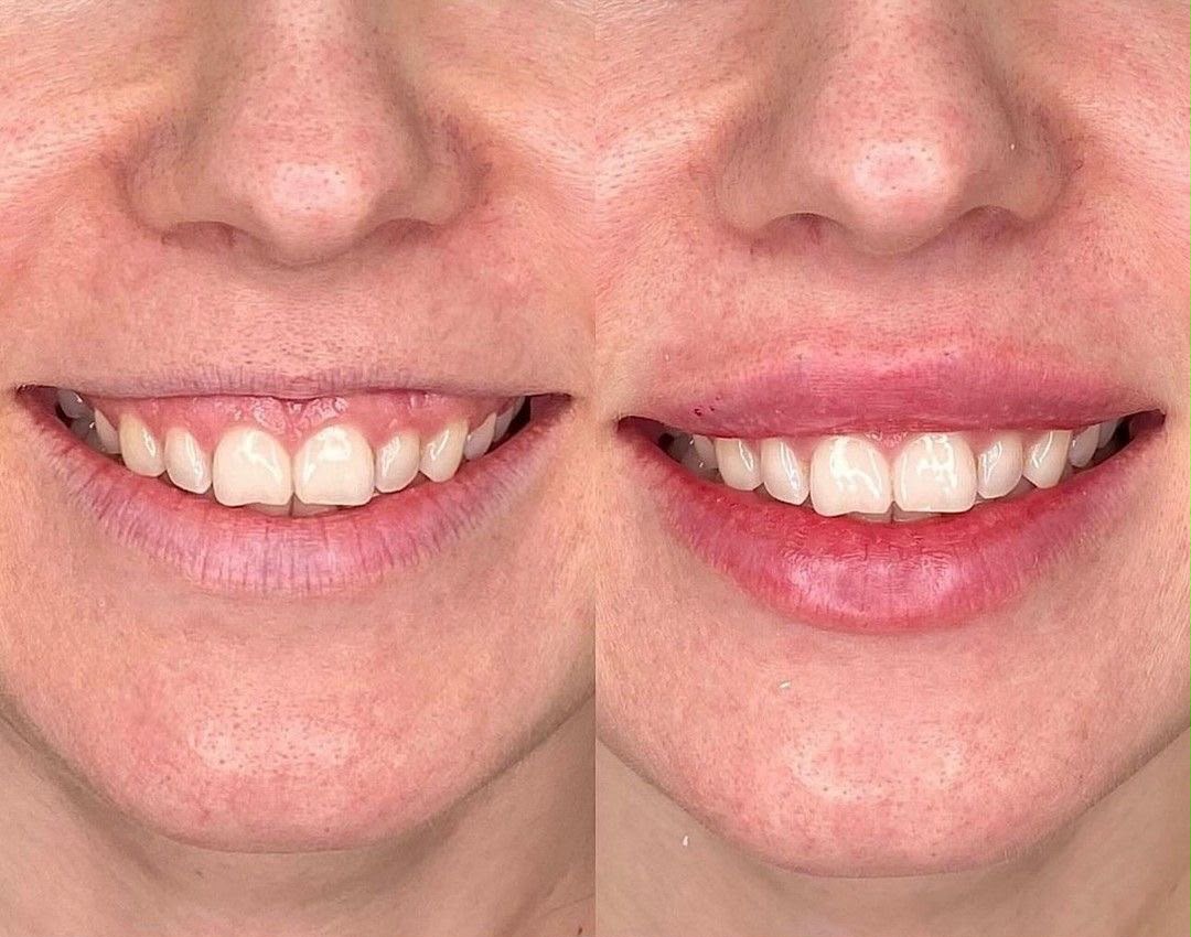 Antes e depois da correção de sorriso gengival com toxina botulínica